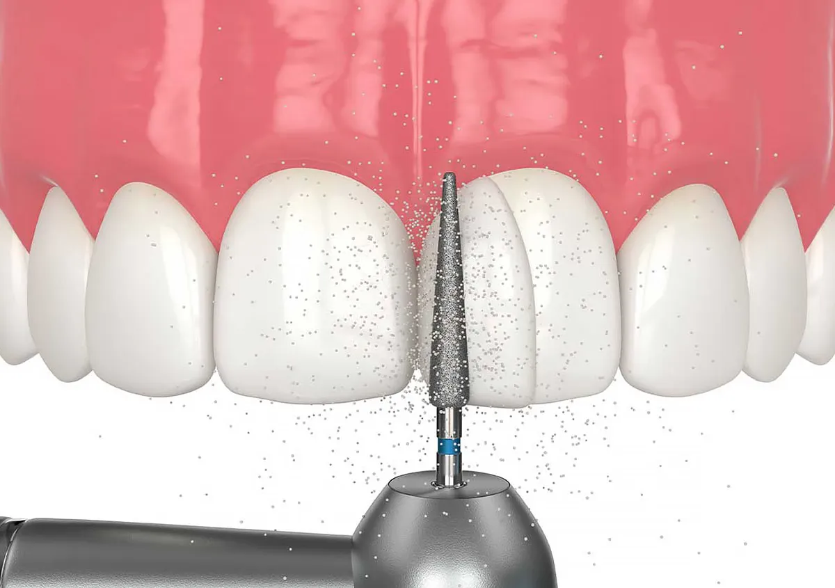 Bonding for Chipped Teeth